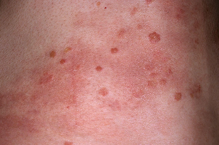 HIV-rashes-zitangira-kwibasira-uruhu-.jpg