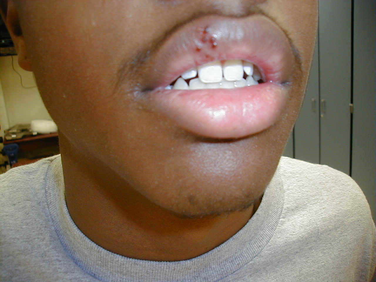 Herpes-ku-munwa-.jpg