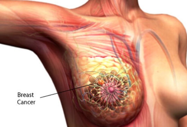 10-things-about-breast-cancer-s2-what-is-breast-cancer.jpg