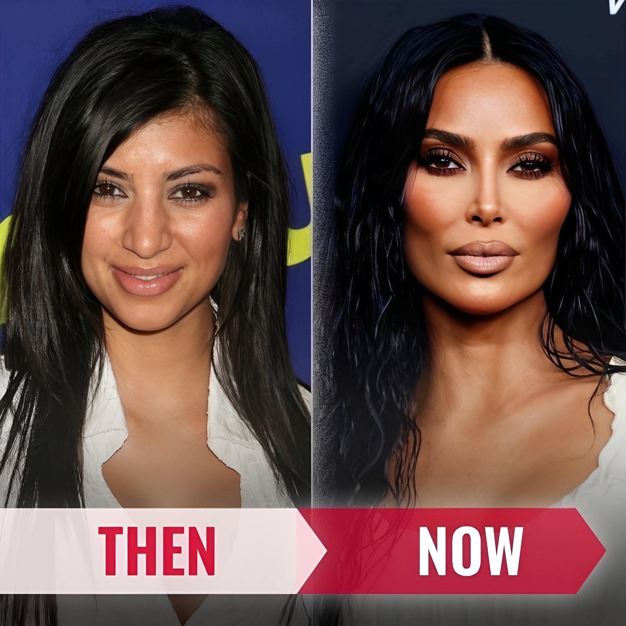 Kim Kardashian Mbere na nyuma yo gukoresha surgery 